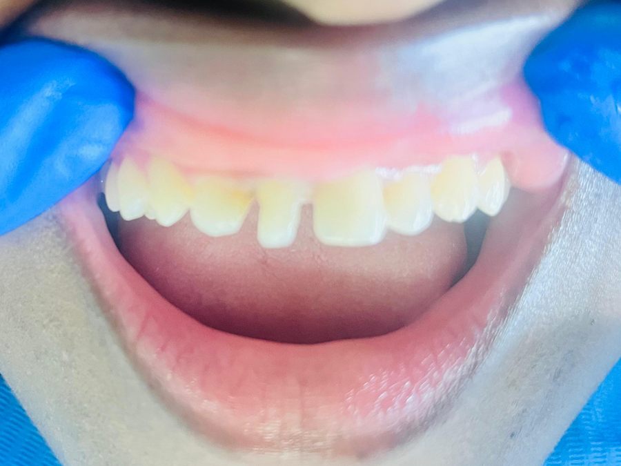 After: upper front teeth repaired