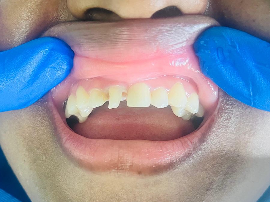 Before: chipped upper front teeth