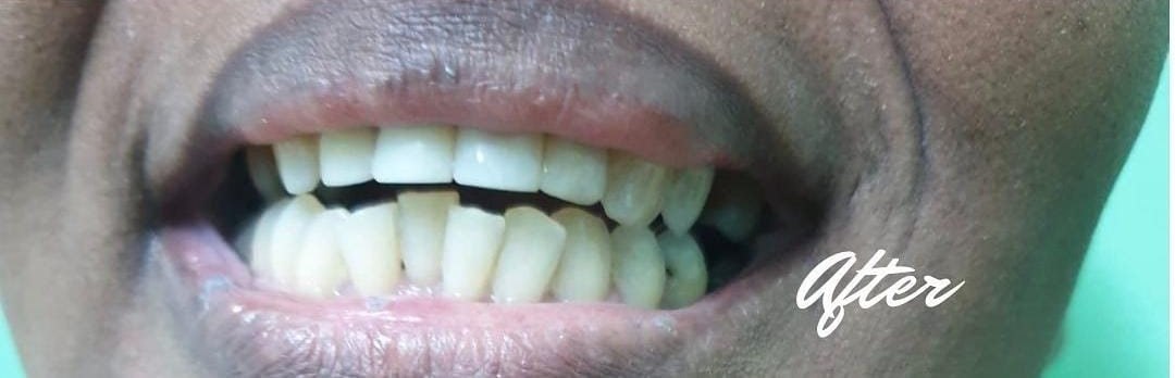 After: restored front teeth